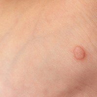 Az orvos lefagyasztotta a szemölcsömet, de nem tűnt el, mit tegyek? Az orvos válaszol