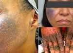 The dangers of using bleaching creams and how to repair the damage