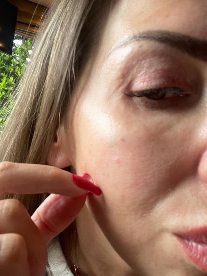 Maja Božović posle tretmana foto: ustupljena fotografija/privatna arhiva 