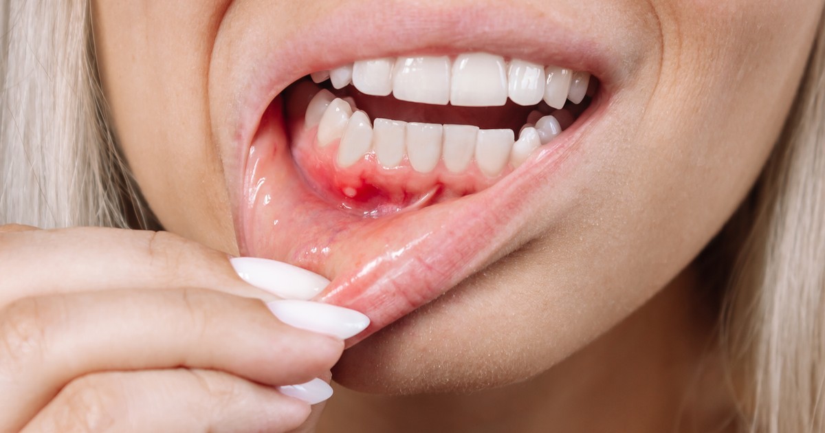 Stan zapalny dziąseł objawy, diagnostyka, leczenie, profilaktyka