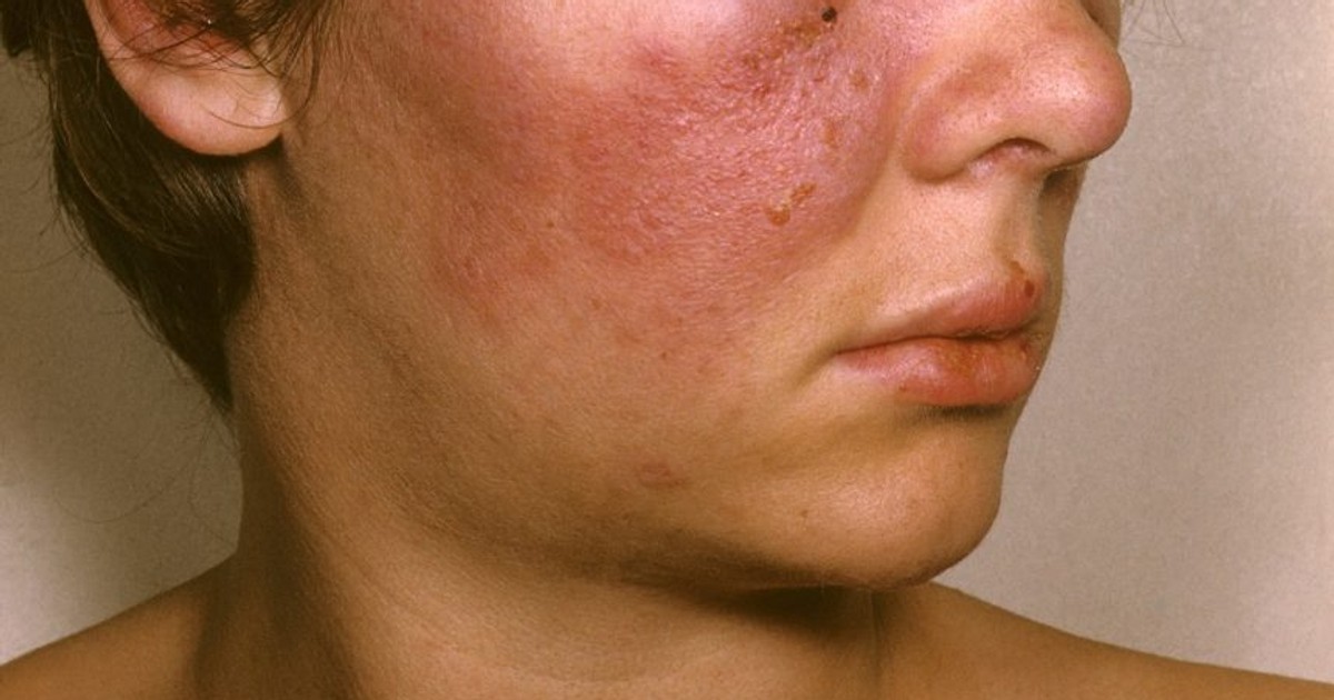 All you need to know about lupus, the deadly autoimmune disease Pulse