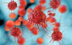 Gwałtowny wzrost liczby nowotworów u osób poniżej 50. roku życia. Najczęściej atakuje...