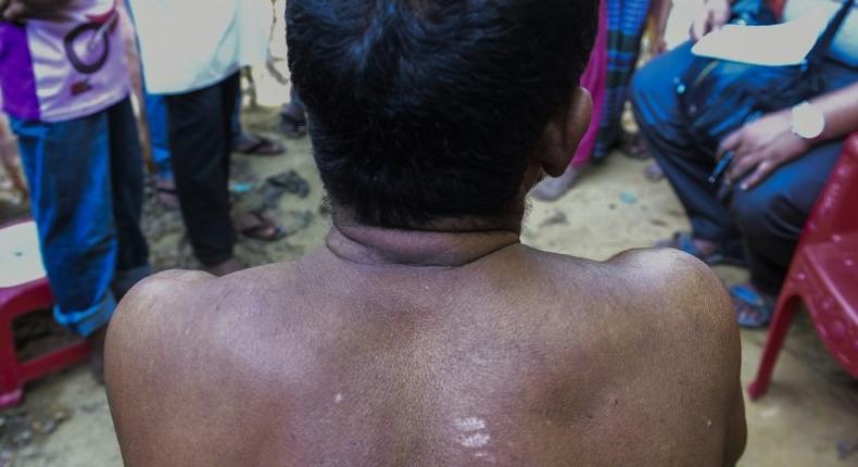 Myanmar Rohingya refugee Din Mohammad shows injuries sustained before he fled to Bangladesh during an interview with AFP in a refugee camp in Ukhyia on November 25, 2016