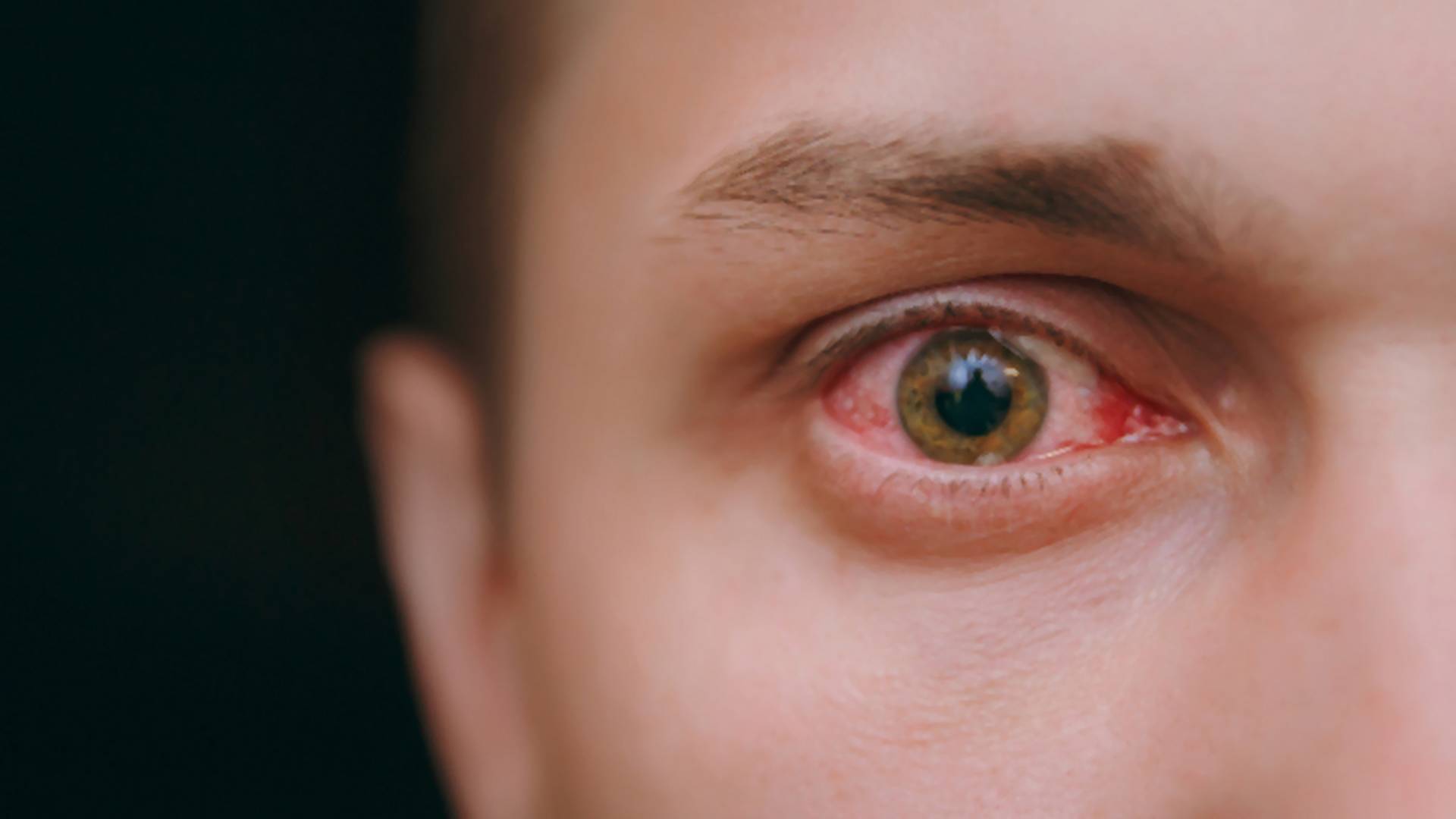 Czerwone Oczy Przyczyny I Jak Radzić Sobie Z Tym Problemem Domowymi Sposobami Ofeminin 4037