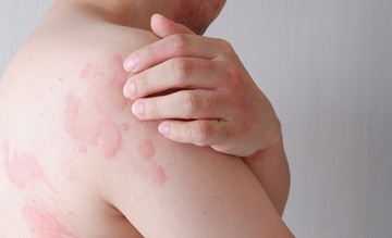 Hisztamin intolerancia: szívritmuszavar is jelezheti