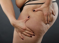 TO siedzi w genach! Przeczytaj, zanim zaczniesz walczyć z cellulitem