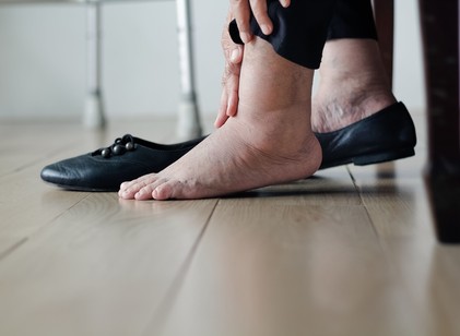Lábdagadás esetén mire figyeljek repülés, búvárkodás közben? Az orvos válaszol című cikk nyitóképe