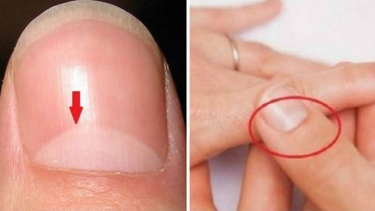 Charakterystyczne, białe półkola na paznokciach występują u większości osób. Nie u wszystkich wyglądają one jednak tak samo. Istnieją bowiem osoby, u których są praktycznie niewidoczne. Przekonajcie się, co to oznacza.
