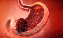 RAK ŻOŁĄDKA za późno wykrywany. Badacze sprawdzają nowy schemat leczenia