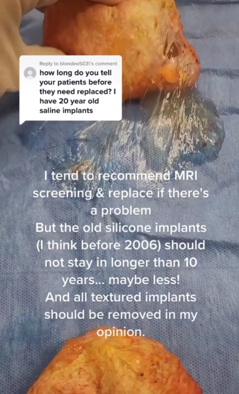 Pacientke vyoperovali 35 rokov staré silikóny. 