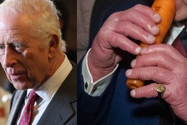 Ja sam lekar i evo zašto kralj Čarls ima ZABRINJAVAJUĆE NATEČENE PRSTE: Ako se ne leči na vreme, može doći do teških unakaženja i invaliditeta