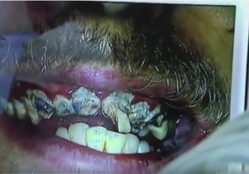 Odvratno zar ne? Sigurni smo da ne želite ovako nešto u svojim ustima