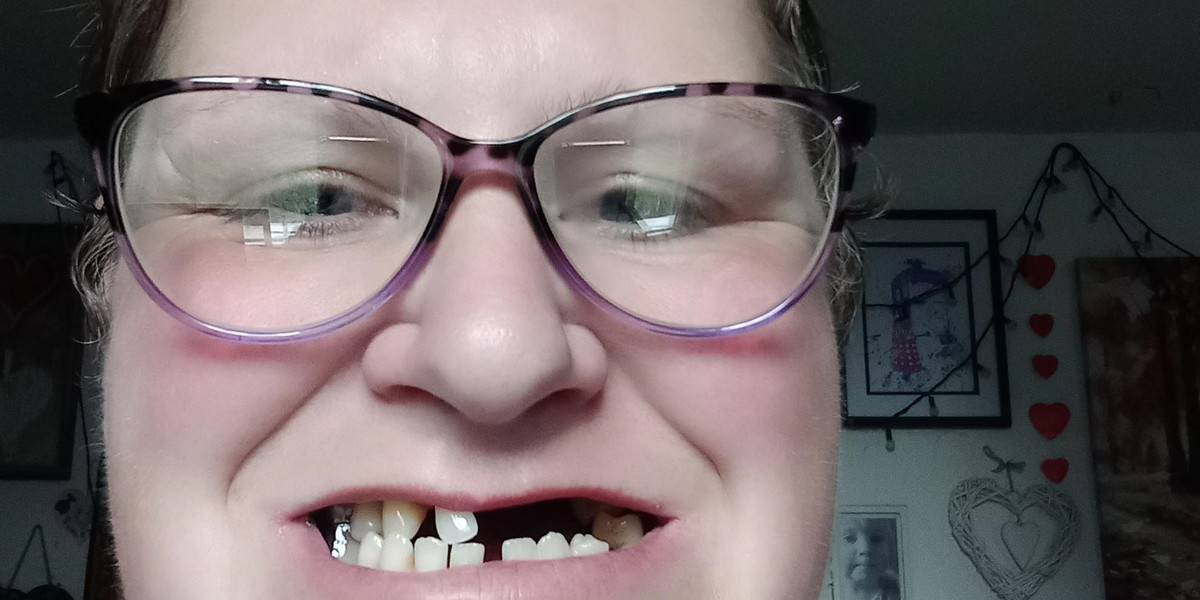 Wyrwała sobie 11 zębów, bo nie mogła się dostać do dentysty