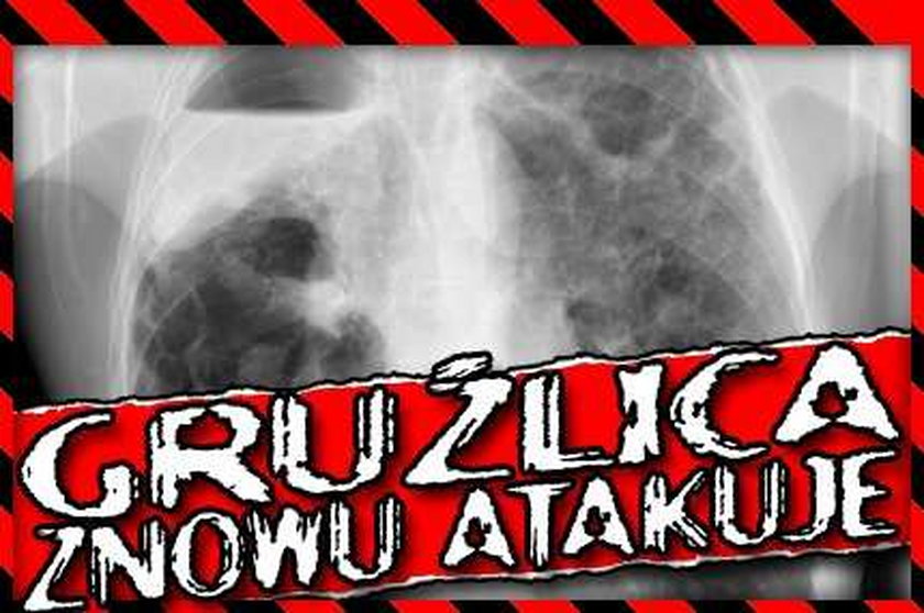 Gruźlica znowu atakuje!