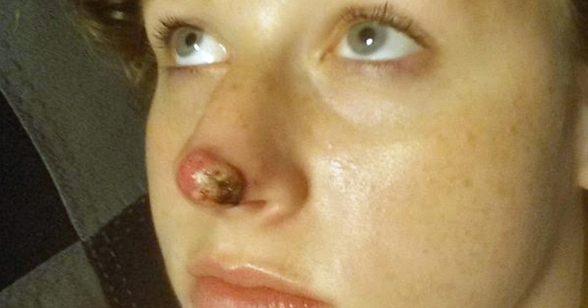 Marisha Dotson zauważyła krostę na twarzy. Okazało się, że to rak!