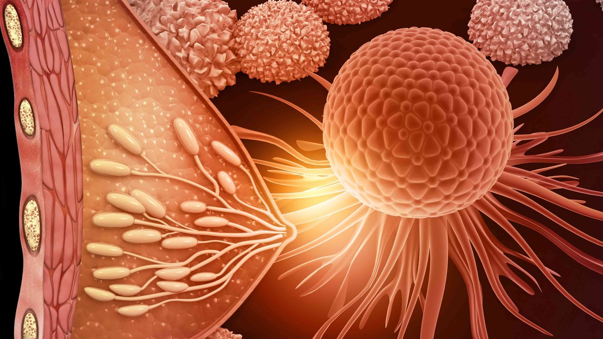 Limfom dojke je redak tip ne-Hodžkinovog limfoma