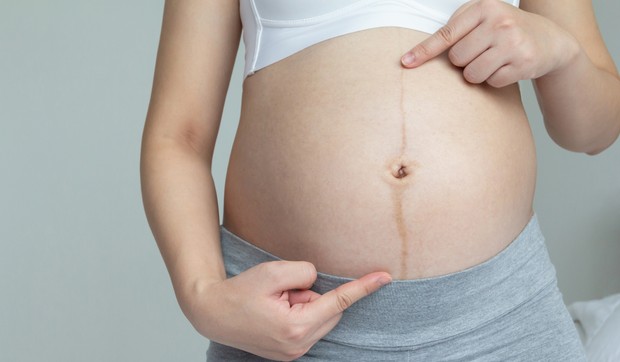 Linea nigra se proteže od pupka do pubične regije