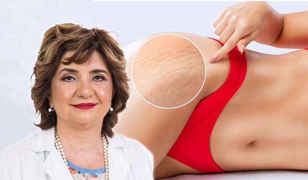 Ako celulit dolazi zajedno sa hormonskim, cirkulatornim ili upalnim simptomima, neophodno je da se potraži mišljenje više stručnjaka 