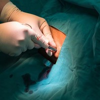 Feleslegessé válhatnak a beültethető defibrillátorok