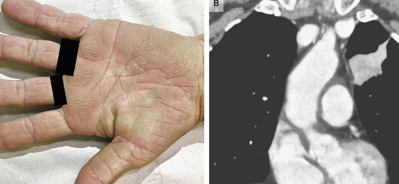 Dziwne zmiany na dłoniach. Nietypowy objaw raka płuc