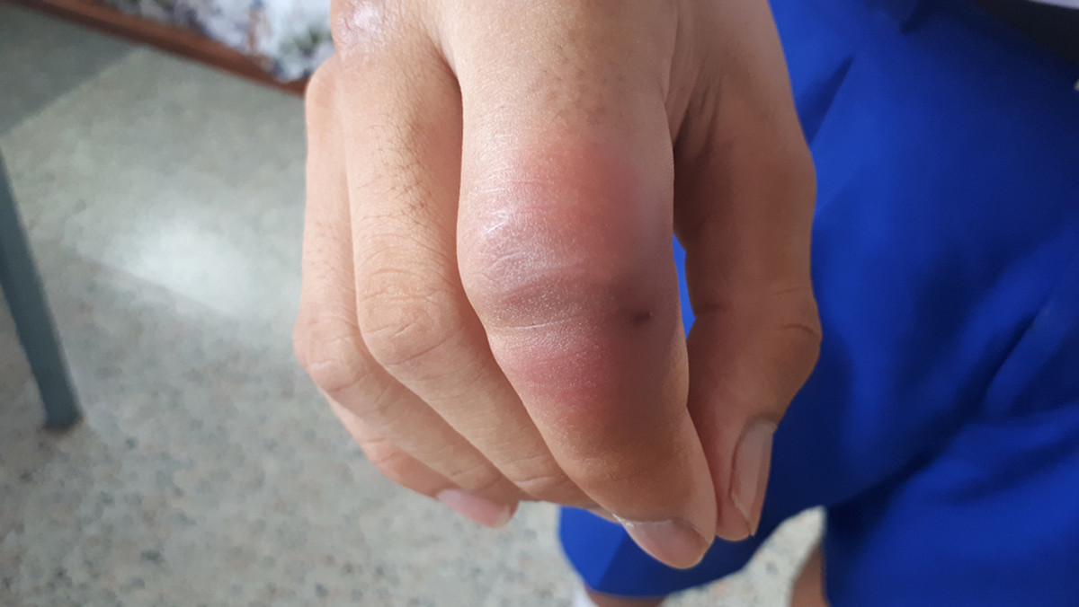 Spuchnięty palec może być objawem gruźlicy. 42-latka z Kalifornii zgłosiła się do lekarza z bólem i obrzękiem małego palca. Kobieta nie mogła sobie przypomnieć, aby się zraniła, jednak od tygodnia na jej dłoni obecna była opuchlizna. Okazało się, że to gruźlica.