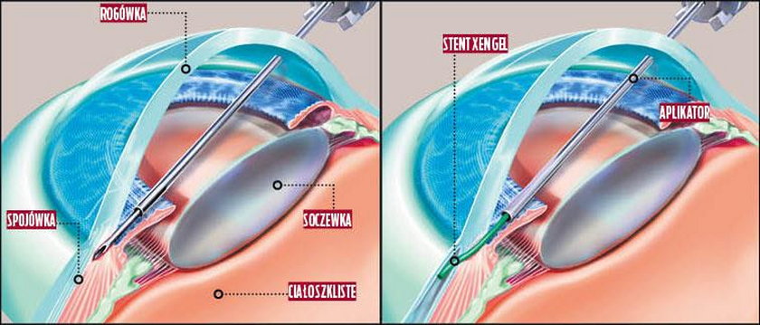 Wszczepienie miniaturowego implantu XEN Gel,  to nowatorska małoinwazyjna metoda w chirurgicznym leczeniu jaskry