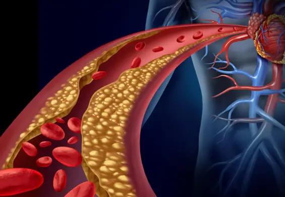 Cholesterol LDL – jakie są jego normy. Dieta obniżająca "zły cholesterol"