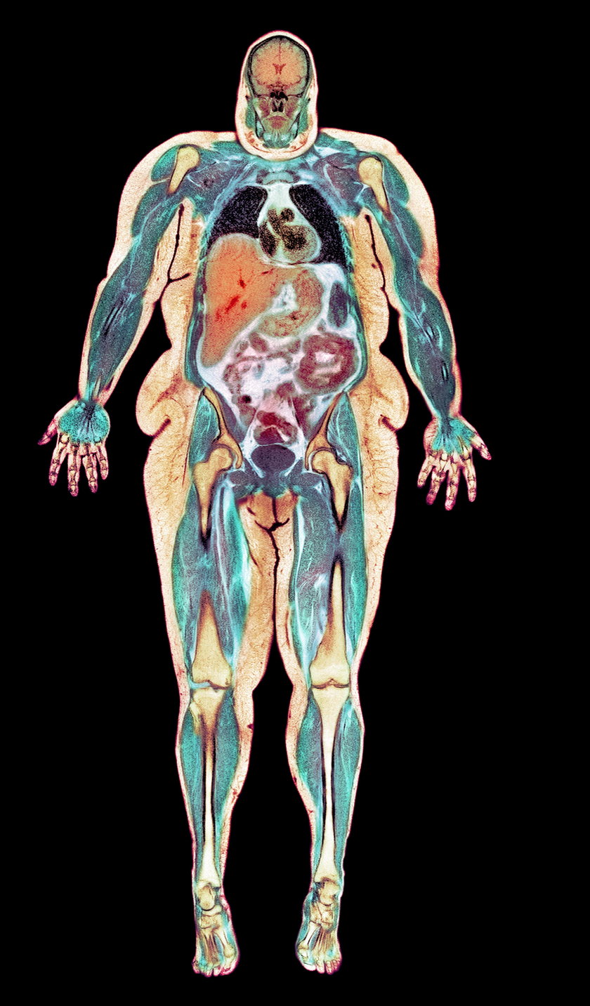 Obraz otyłej kobiety w rezonansie magnetycznym. Czerwony trójkąt w centrum zdjęcia to powiększona wątroba, powyżej – czarne – widoczne są zgniatane płuca