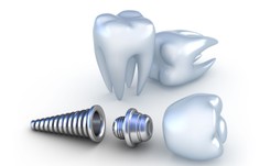 Utracony ząb? Te fakty o implantach zębów musisz znać