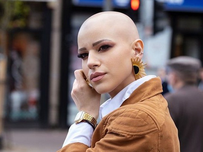 Sonja je zbog alopecije izgubila kosu, a posle godinu dana je opet počela da joj raste
