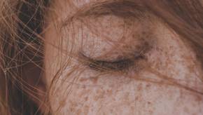 Pigmentflecken entfernen – Die beste Creme für Gesicht & Körper