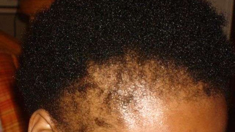 Hair Treatment Tips 4 Natural Ways To Stop Hair Loss Article