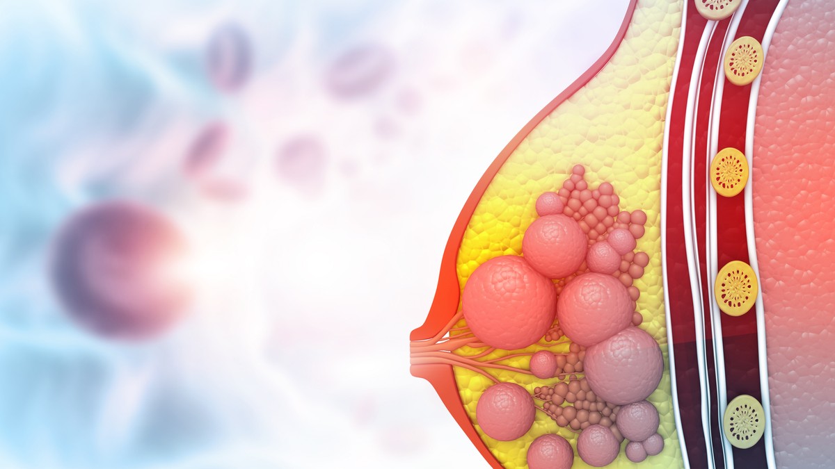 Duktalni karcinom in situ je jedan od najčešćih oblika raka dojke kod žena