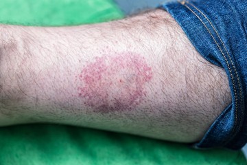 Nem minden kullancs hordoz betegségeket, ám ha találtunk egyet a bőrünkben, mindenképpen oda kell figyelnünk az esetleges tünetekre. A Lyme-kór legjellegzetesebb tünete a kokárdára hasonlító bőrelváltozás, ami általában a csípés után 3-30 nap múlva jelentkezik. A bőrelváltozás idővel egyre kiterjedtebbé válik és középen feltisztul, így egy vörös színű kört rajzol ki, ami akár a 30 cm-es átmérőt is elérheti. Van, akinél nemcsak a csípés helyén jelenik meg ez a bőrelváltozás, hanem a test egyéb területein is. Egyes esetekben azonban a bőrelváltozás vagy nem ennyire jellegzetes, vagy meg sem jelenik.