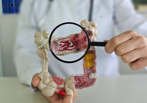 Rak debelog creva raste u svakoj starosnoj grupi mlađoj od 50 godina