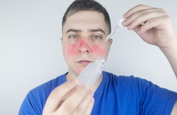 rosacea, bőrápolás, kipirosodás