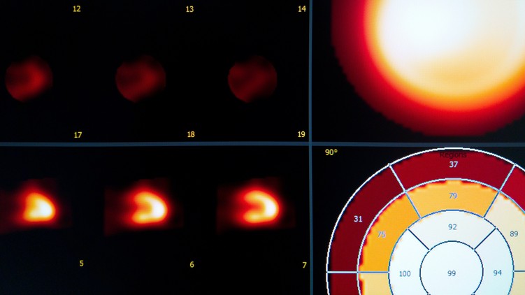 szkintigráfia szcintigráfia izotópos vizsgálat leírás