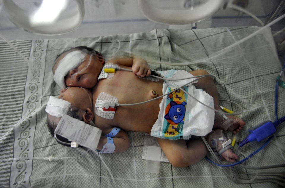 CHINA TWO-HEAD CONJOINED TWIN BABIES