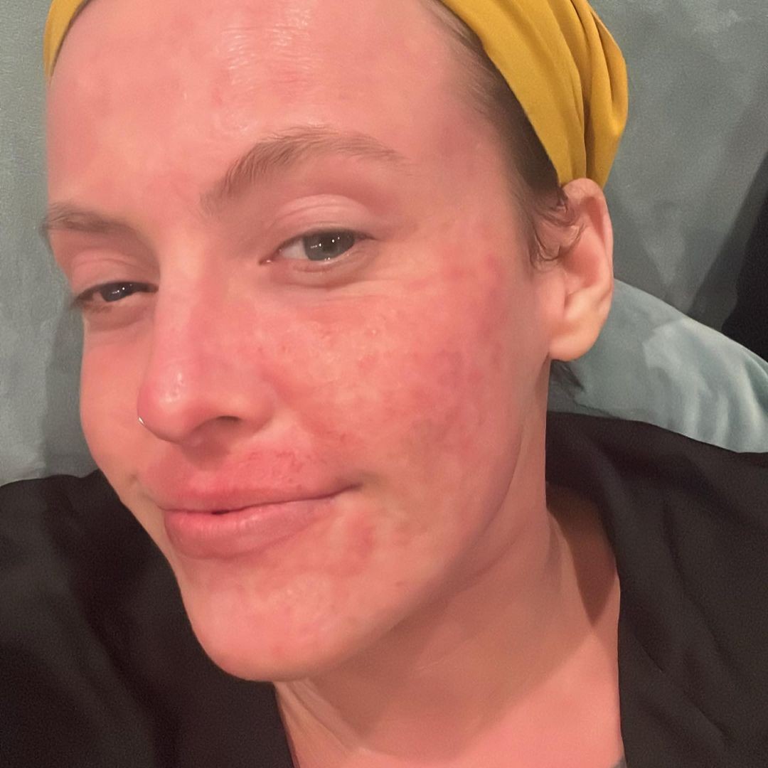 Daisy trpela ekzémom 20 rokov a kvôli svojmu kožnému stavu nechcela vychádzať z domu. 