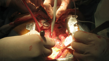 Przełom w transplantologii: przeszczepiono niebijące serca