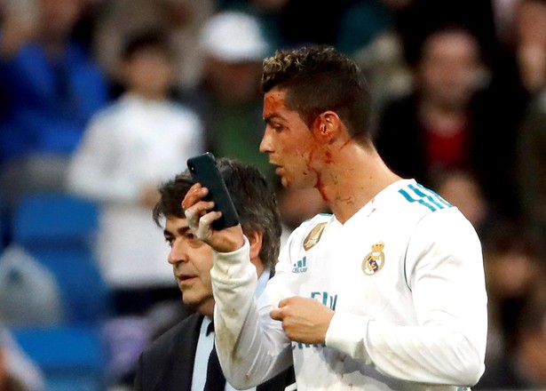 Blizna szpeci twarz Cristiano Ronaldo. Real Madryt opublikował nagranie z szatni