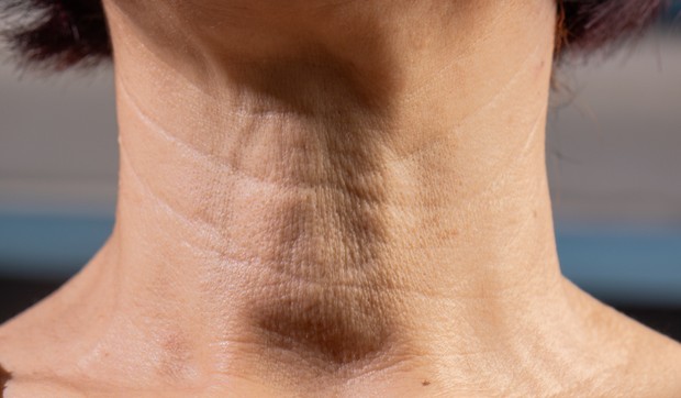 "Ćureći vrat" na koži je estetski termin za opuštenu kožu i nakupljene masnoće ispod brade i na vratu