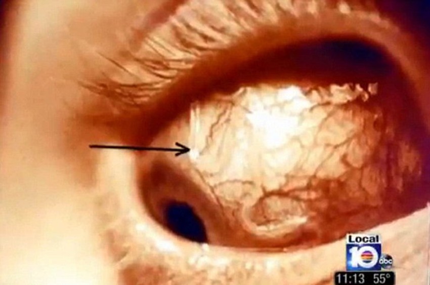 Parazit se jasno video u Ešlinom oku