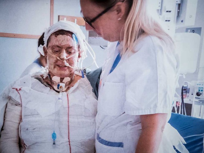 Ema je iz stravičnog požara spasila šestoro dece, evo kako izgleda posle 20 operacija