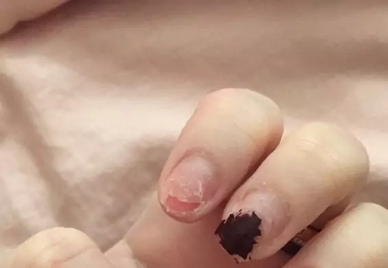 Blogerka pokazała paznokcie zrujnowane po akrylu-to bardzo bolesne!