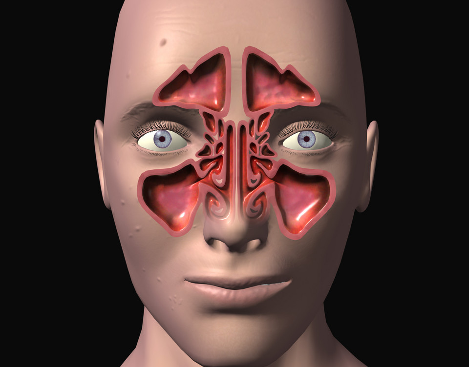 Орвис синусит. Гайморовы пазухи гайморит. Гайморовы пазухи анатомия гайморит. Орвис синусит. Орвис синусит.