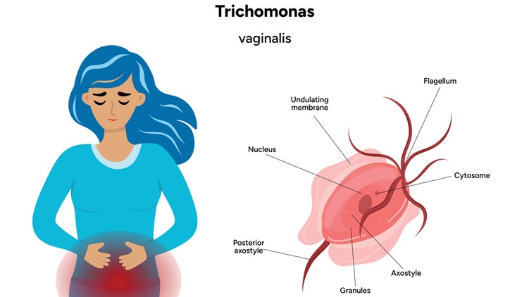 Trichomonas-fertőzés tünet vizsgálat kezelés
