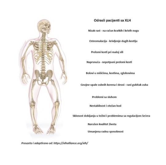 Osteomalacija