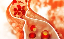 21 mln Polaków ma zbyt wysoki poziom cholesterolu, grożący zawałem i udarem