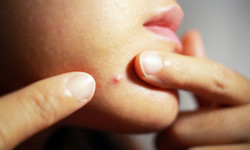 Jak wycisnąć pryszcza, żeby nie uszkodzić skóry? Jeśli nie umiesz trzymać rąk przy sobie, przestrzegaj tych zasad